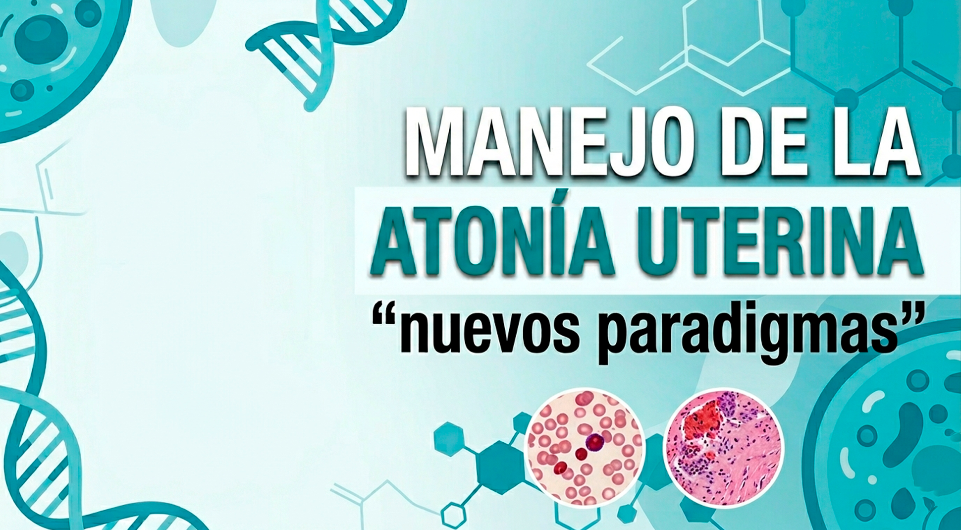 Manejo de la atonía uterina 